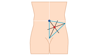 Stoma marking