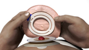 How to apply a 2-piece adhesive stoma bag
