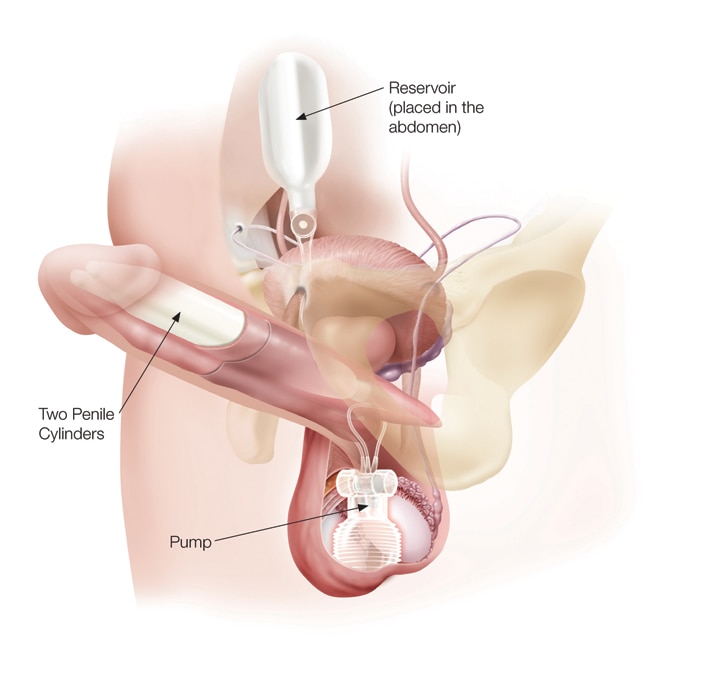 Titan penile implant