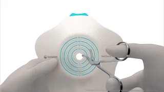 SenSura Mio Concave 2-piece Uro