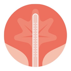 <p>Complete bladder emptying<sup>1</p>