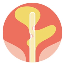 <p>No discomfort during catheterisation<sup>7</p>