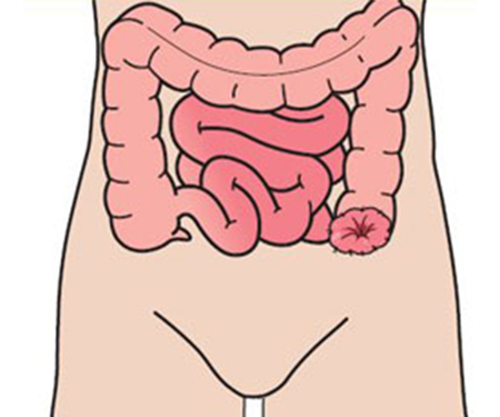 What is a colostomy?