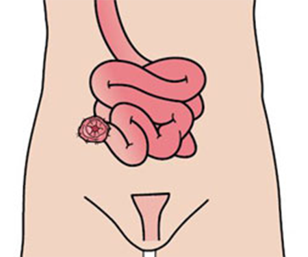 What is an ileostomy?