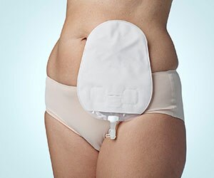 Urostomy